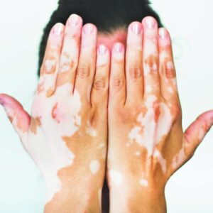 Vitiligo