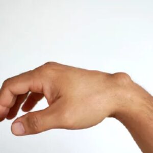 Lipoma
