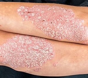 Psoriasis